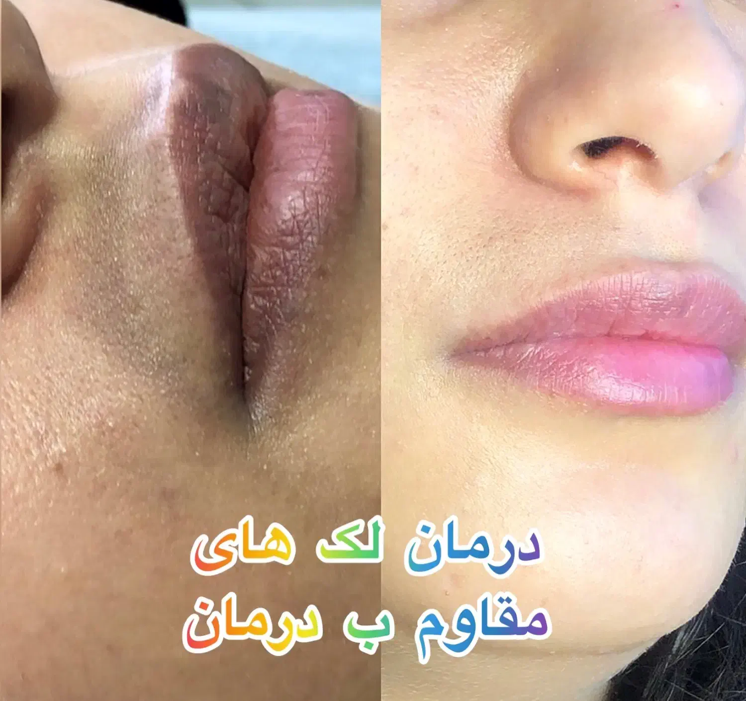 کاموفلاژ رفع تیرگی قطعی زیرچشم و لک|خدمات آرایشگری و زیبایی|تهران, شکوفه (عبدل آباد)|دیوار