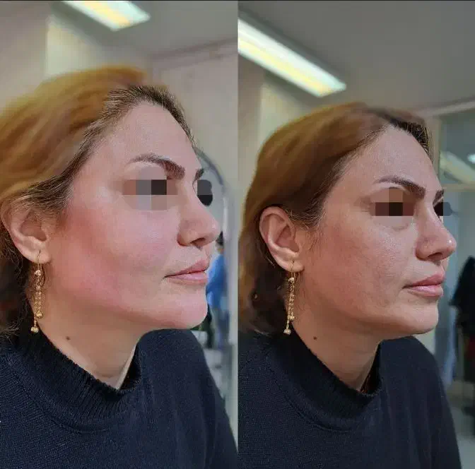 تزریق چربی ژل بوتاکس|خدمات آرایشگری و زیبایی|خرم‌آباد, |دیوار