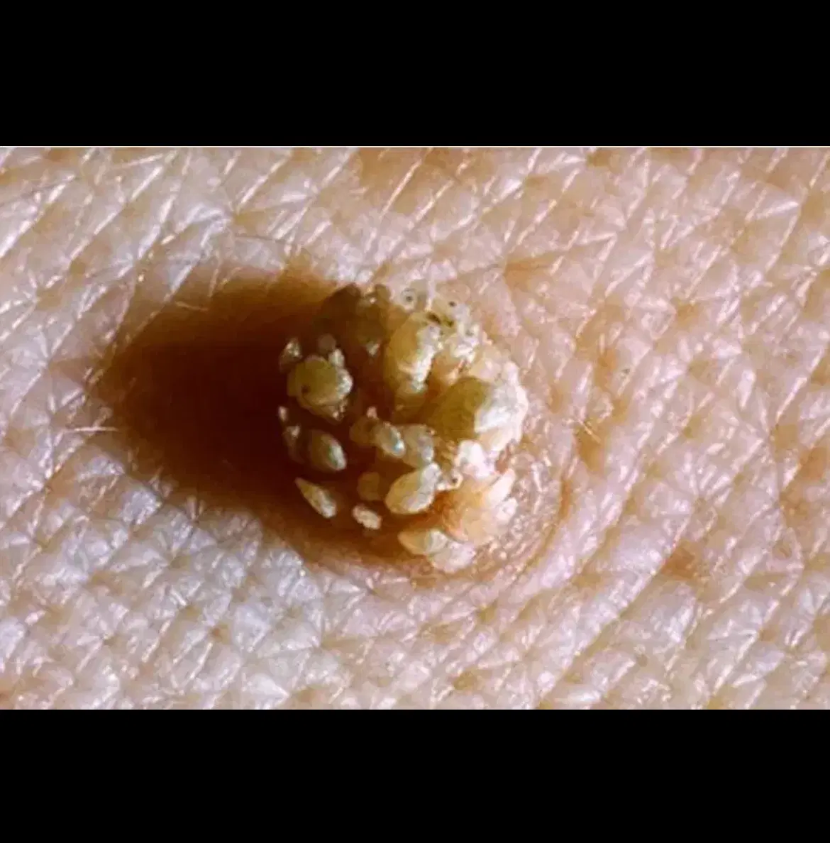 کلینیک درمان زگیل پوستی/کرایوتراپی و لیزر/HPV|خدمات زیبایی و سلامت|اهواز, کیانپارس |دیوار