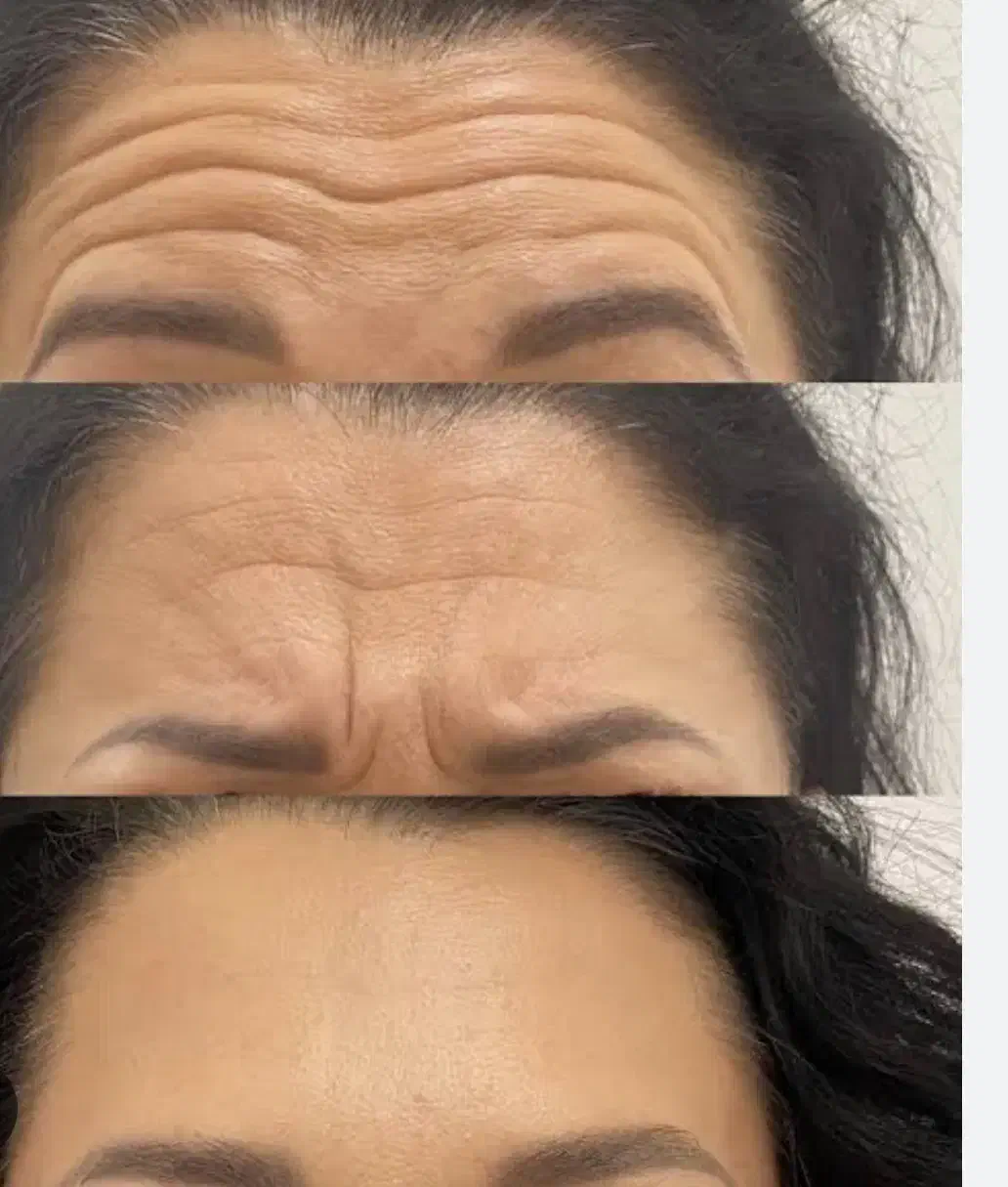 تزریق بوتاکس مصپورت و فیلر توسط پزشک فقط ۱ ملیون|خدمات آرایشگری و زیبایی|اصفهان, چشمه باقرخان|دیوار