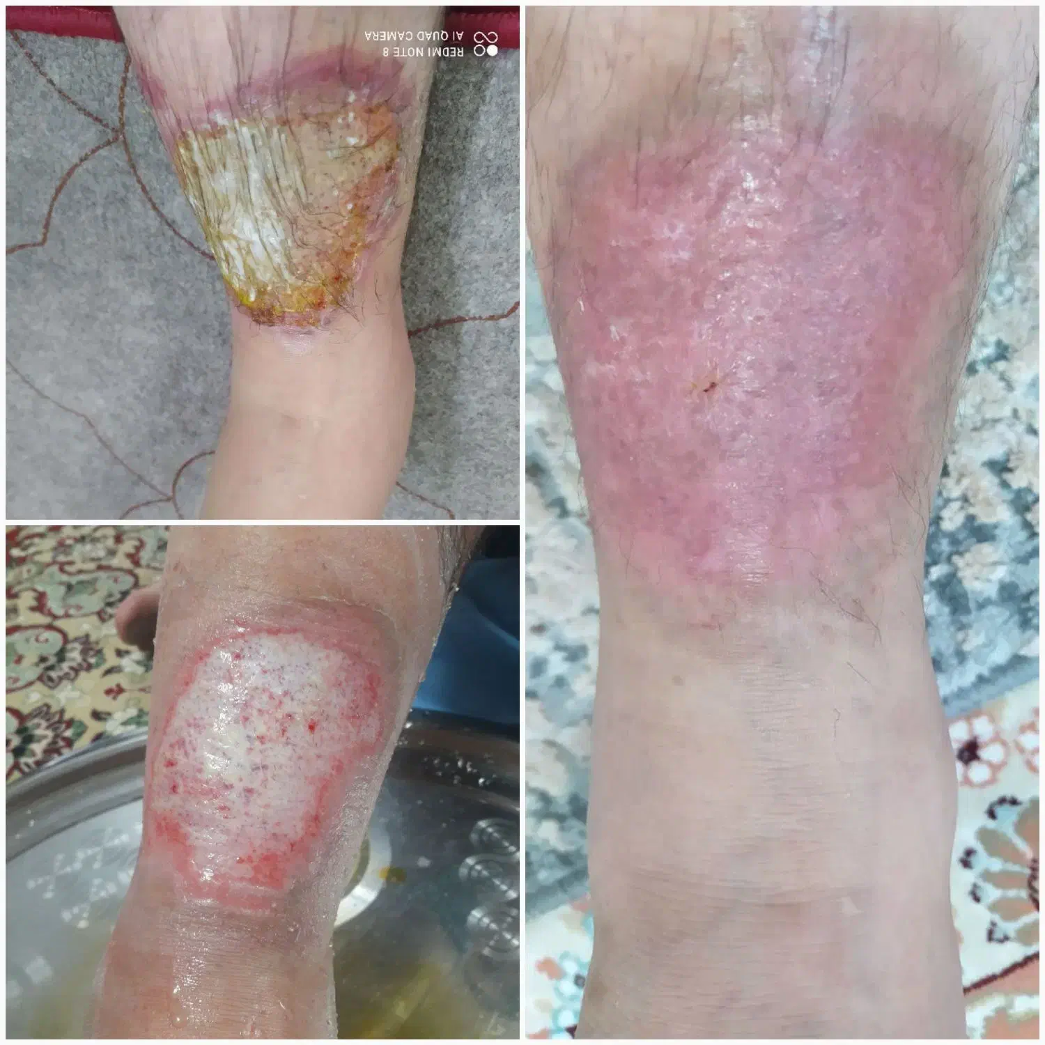 کارشناس تخصصی زخم و استوما|خدمات آرایشگری و زیبایی|قم, زنبیل آباد|دیوار