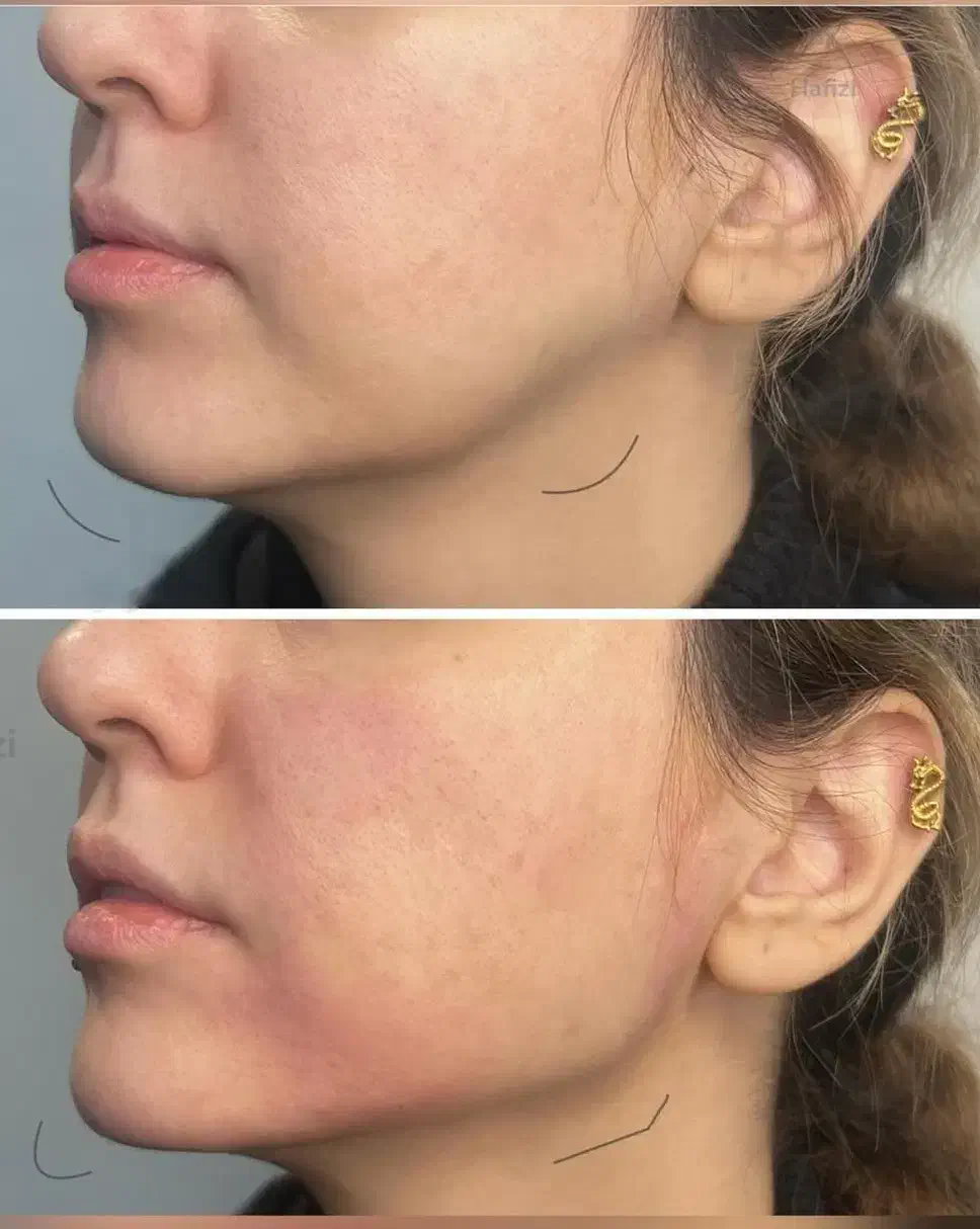 تزریق ژل و بوتاکس تضمینی|خدمات آرایشگری و زیبایی|اهواز, نادری|دیوار
