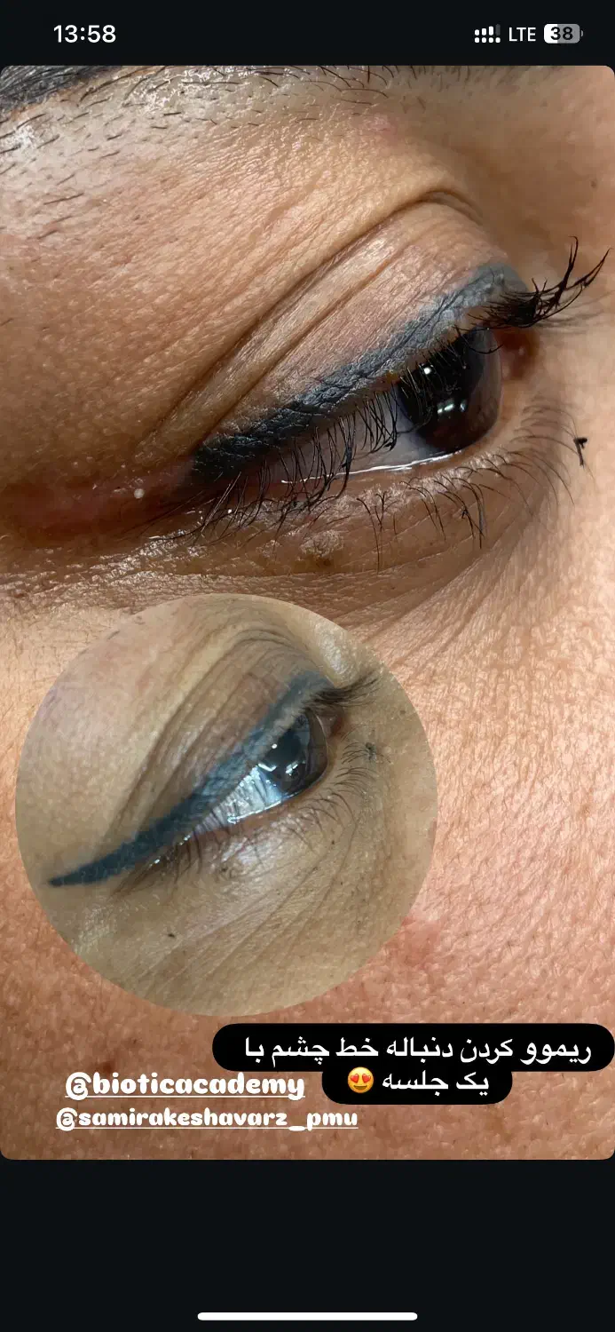 ریموو بایوتیک|خدمات آرایشگری و زیبایی|بم, |دیوار