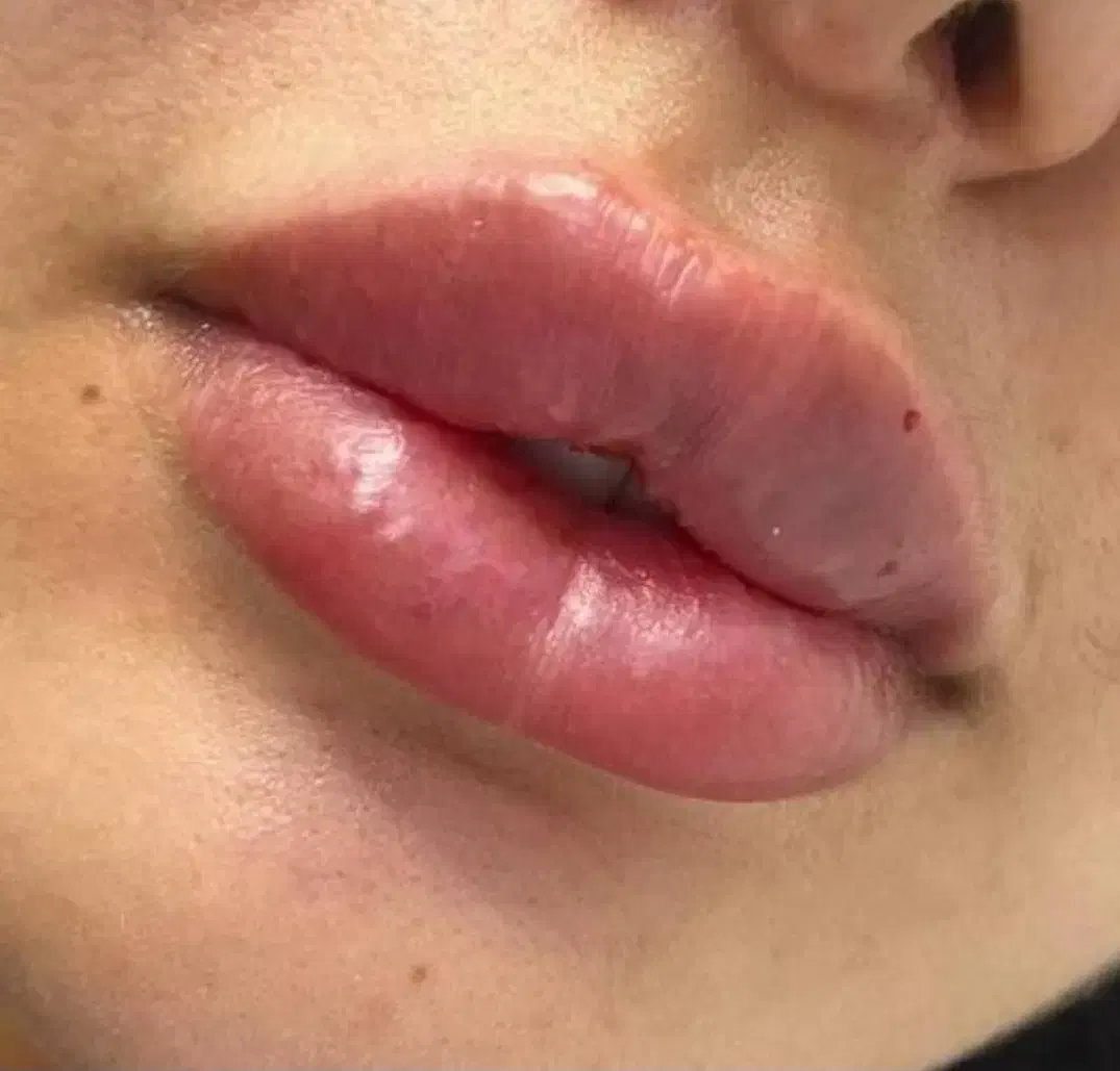 تزریق ژل|خدمات آرایشگری و زیبایی|یاسوج, |دیوار