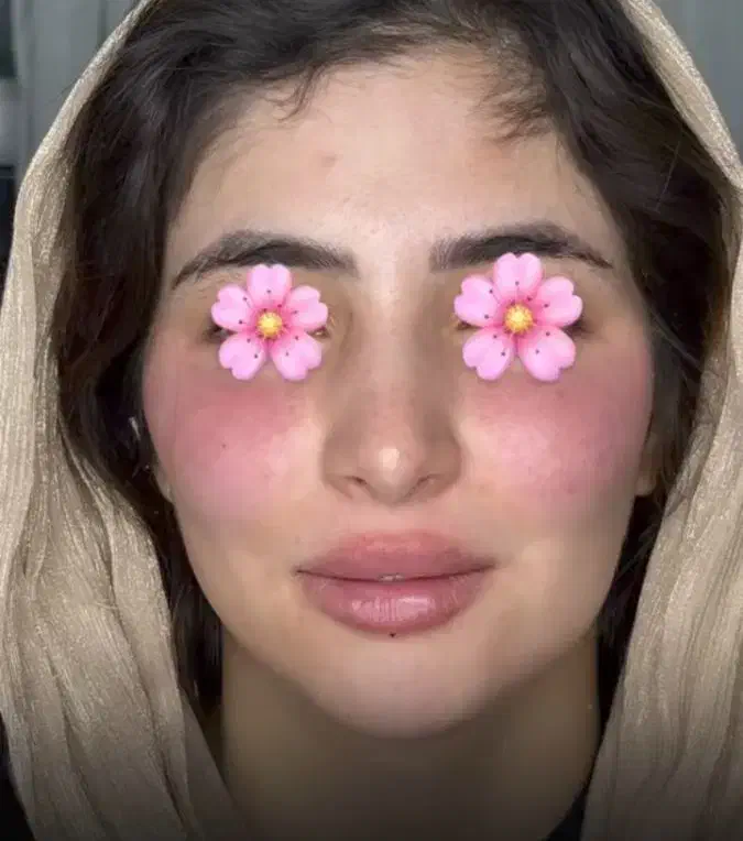 ژل،بوتاکس،مزوتراپی،مزونیدلینگ|خدمات آرایشگری و زیبایی|دوگنبدان, |دیوار