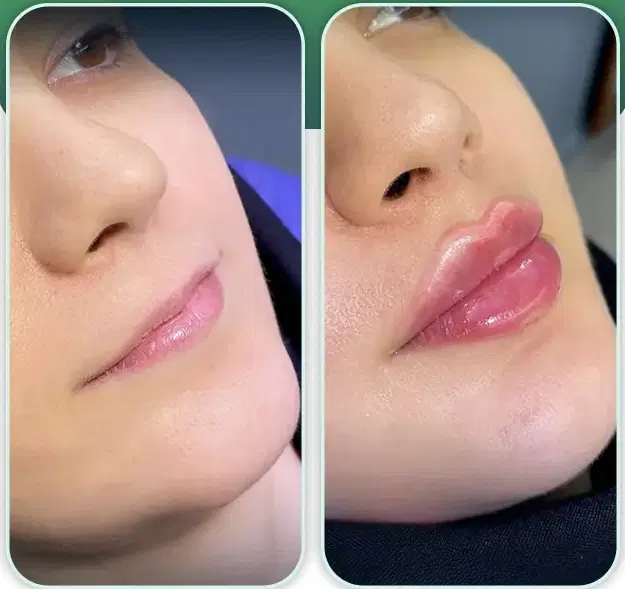 ژل فیلر بوتاکس جوانساز مزوژل آنزیم صورت و بادی|خدمات زیبایی و سلامت|تهران, شهرک شریعتی|دیوار