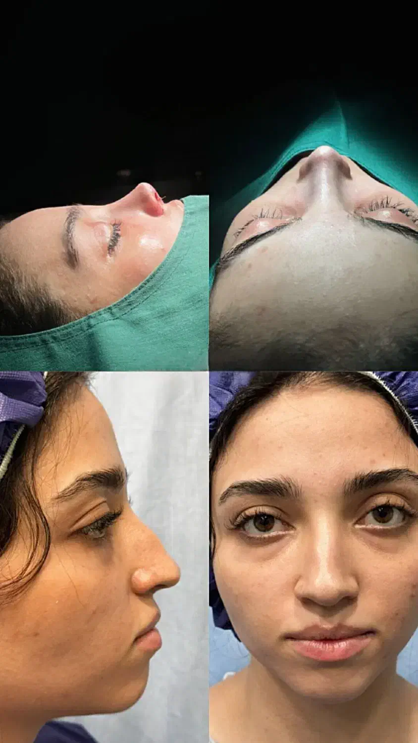 جراحی بینی در تهران با آف ۵۰درصد،جشنواره آذر|خدمات آرایشگری و زیبایی|پاکدشت, پاکدشت (مامازند)|دیوار