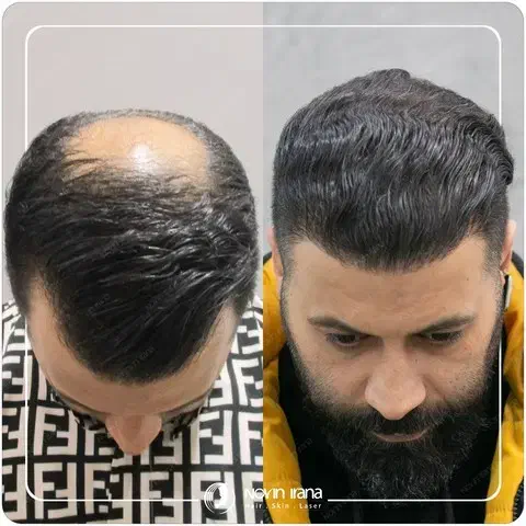 کاشت مو|خدمات آرایشگری و زیبایی|اهواز, نادری|دیوار