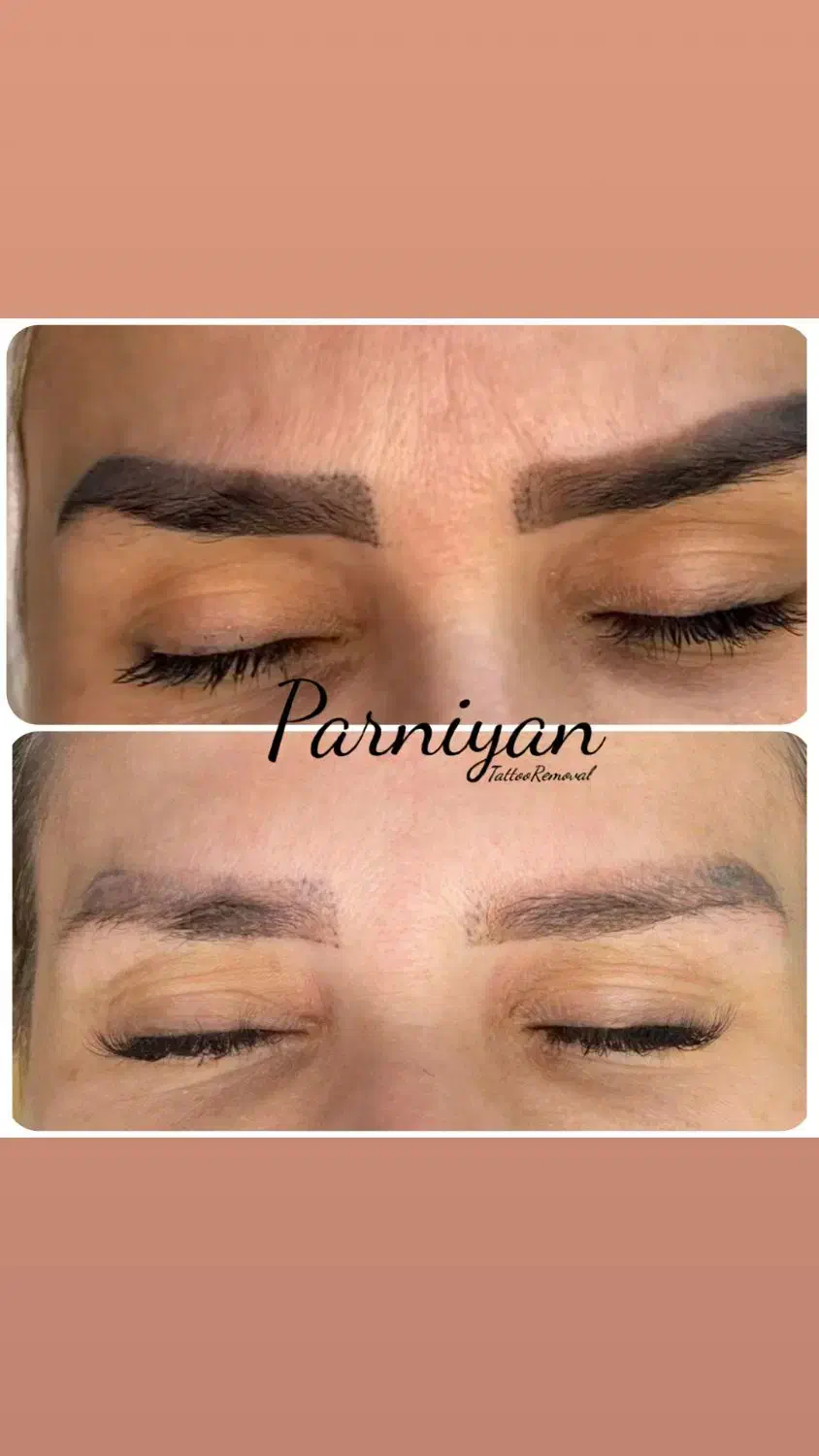 ریموو تاتو، پاک کردن تتو تخصصی کرج، البرز|خدمات آرایشگری و زیبایی|کرج, عظیمیه|دیوار