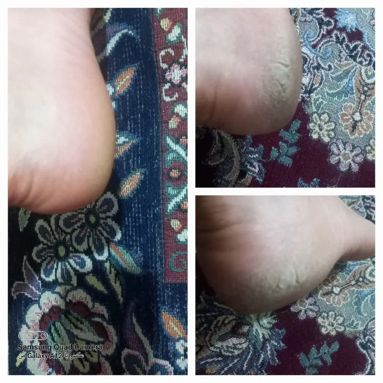 درمان خشکی و ترک پا|آرایشی، بهداشتی، درمانی|تربت جام, امام|دیوار