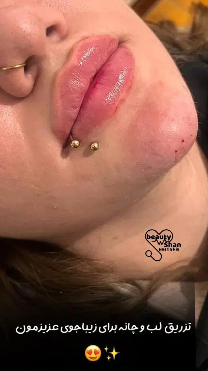 خدمات زیبایی ساکشن و تزریق فیلر های بادی|خدمات آرایشگری و زیبایی|خرمآباد, |دیوار