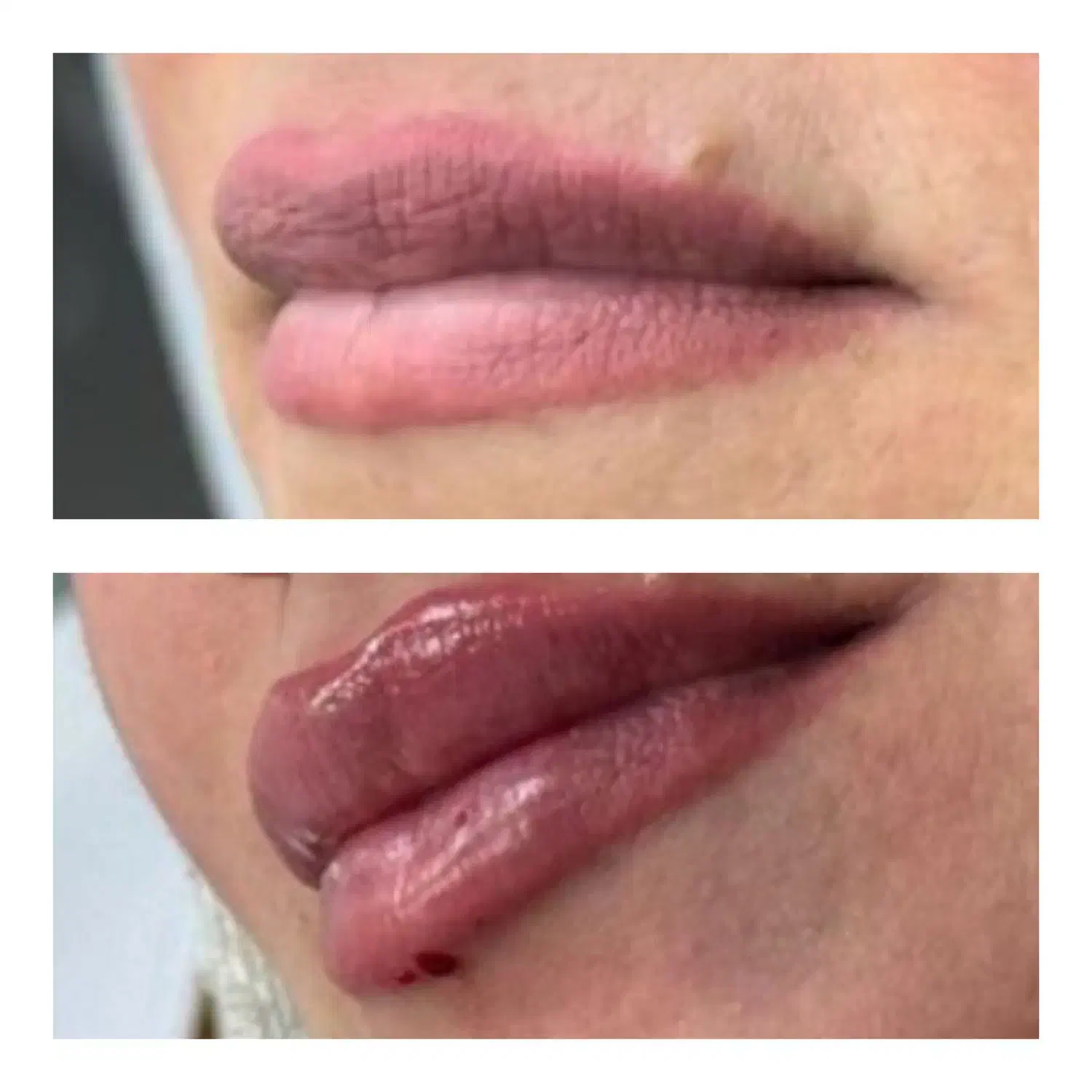 آموزش تزریق ژل لب.ژل گونه بوتاکس انواع مزوتراپی|خدمات آموزشی|آبادان, |دیوار