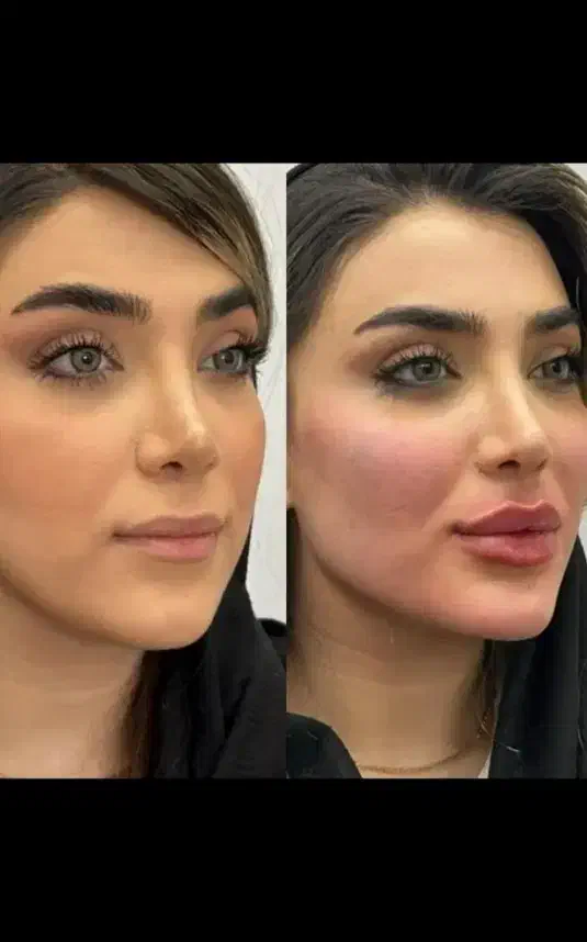 انجام تمام خدمات فیلر|خدمات آرایشگری و زیبایی|شهرکرد, |دیوار