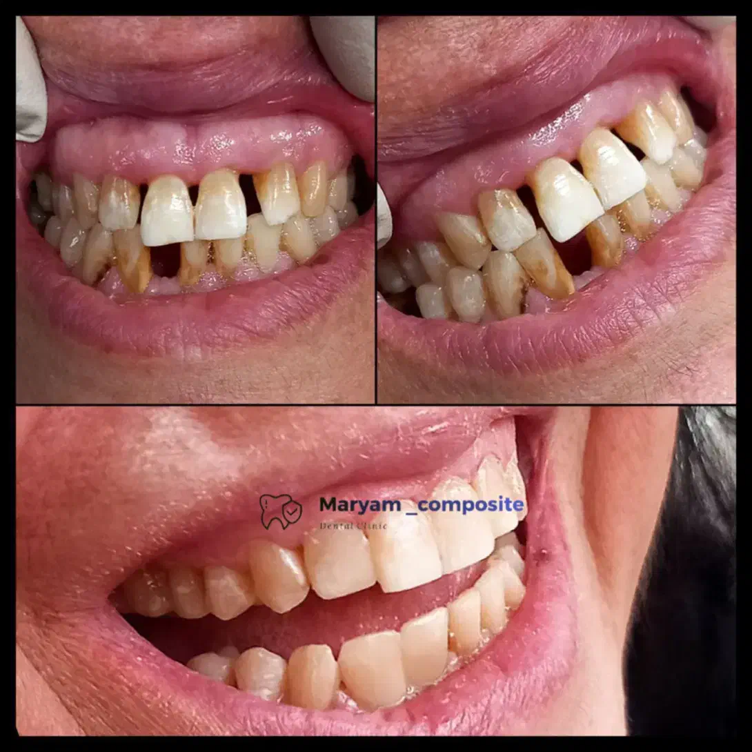 کامپوزیت دندان تعرفه دولتی|خدمات آرایشگری و زیبایی|کارون, |دیوار