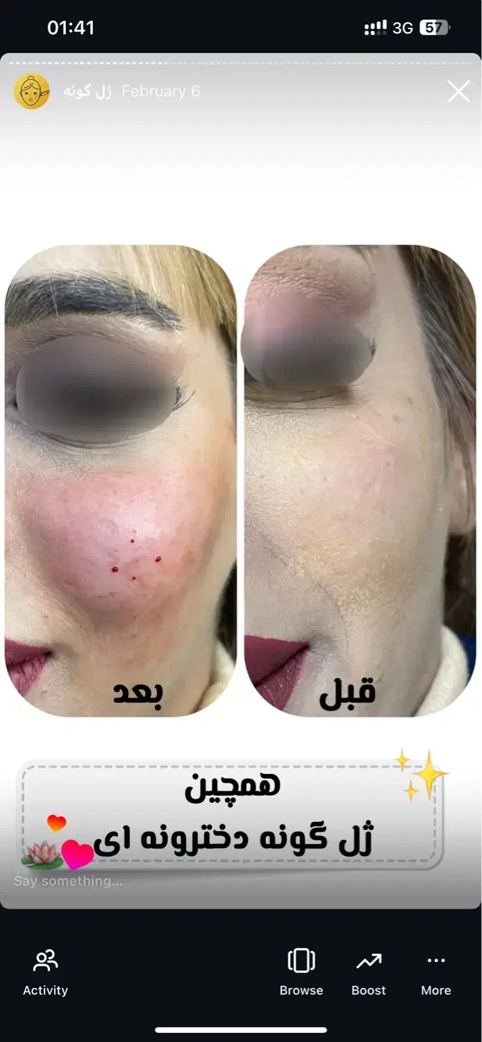 جشنواره تزریق ژل ۳۸۰ هزاروبوتاکس توسط کادردرمان|خدمات آرایشگری و زیبایی|اندیمشک, |دیوار