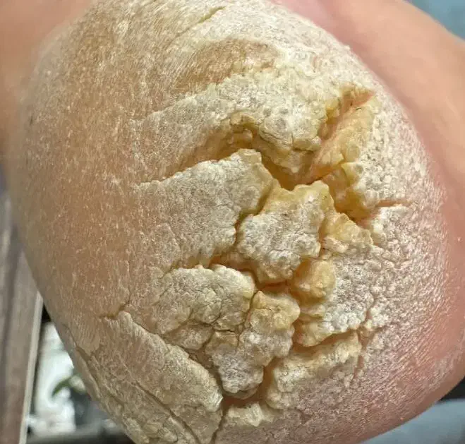 تخفیف ویژه کفسابی درمان ترک پا 270|خدمات آرایشگری و زیبایی|سبزوار, فیاض|دیوار