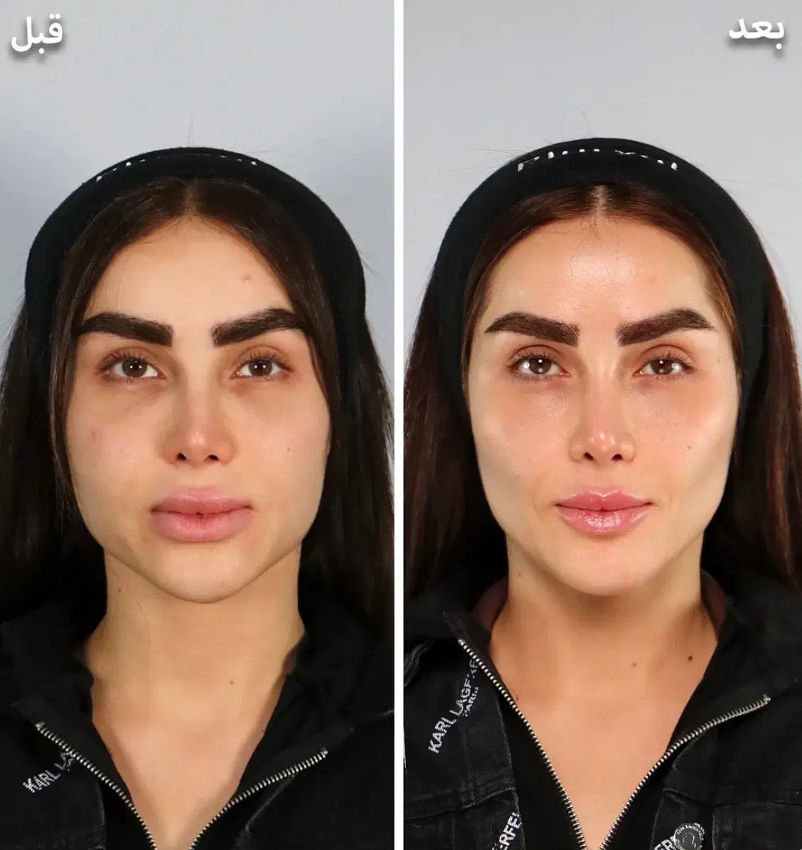 تزریق ژل و بوتاکس و مادلینگ عربی|خدمات آرایشگری و زیبایی|کرمانشاه, |دیوار