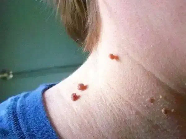 درمان hpv ز.گ.ی.ل|آرایشی، بهداشتی، درمانی|بندرعباس, |دیوار