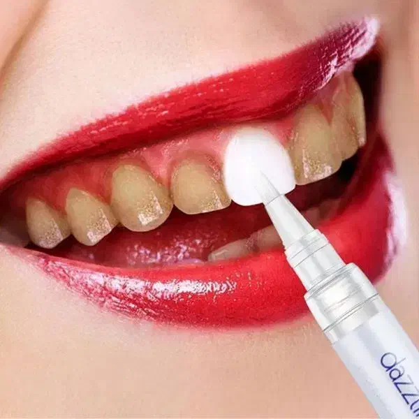 قلم سفید کننده دندان /لمینت/زیبایی/کامپوزیت|خدمات آرایشگری و زیبایی|اردبیل, |دیوار