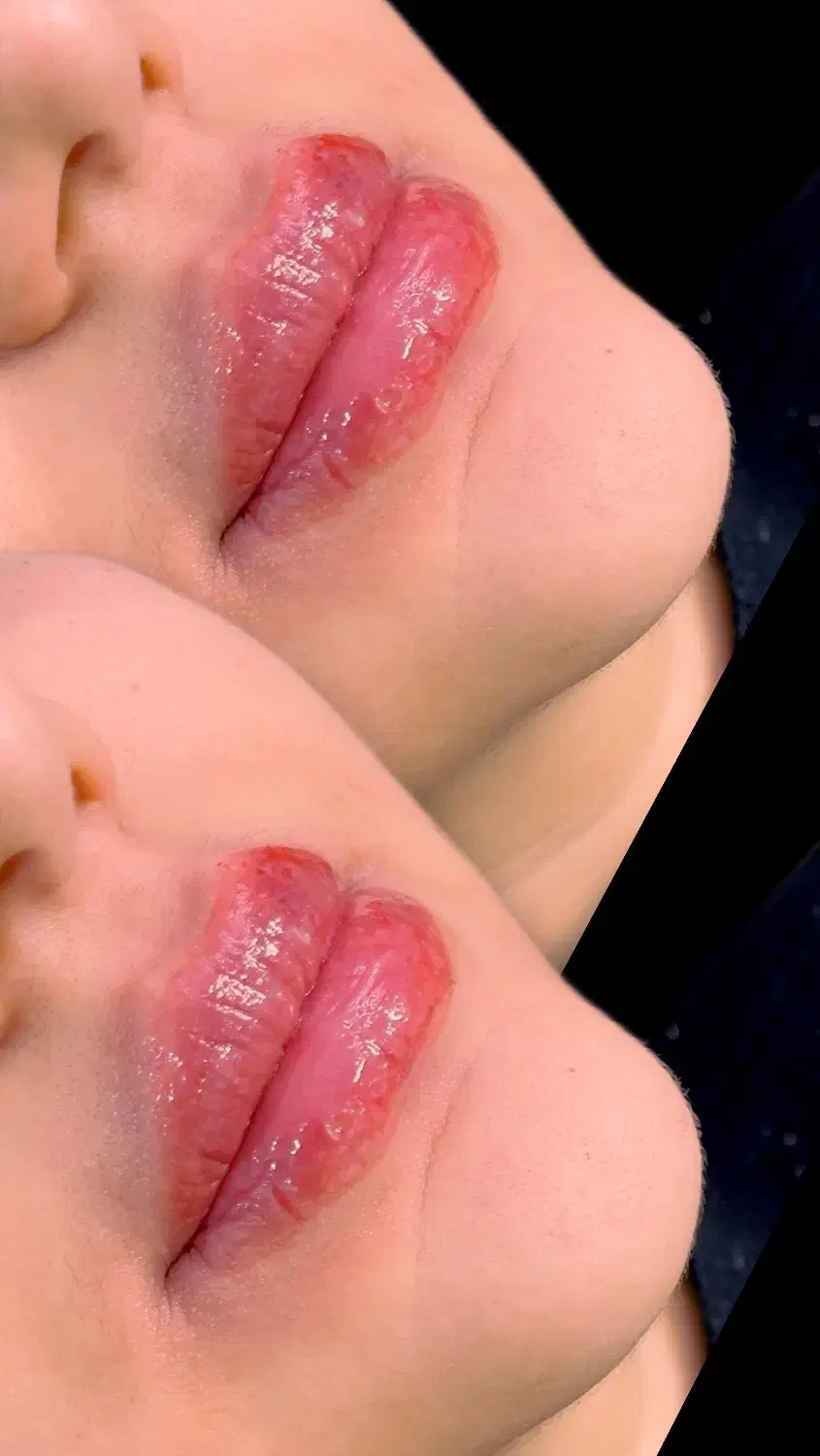 ژل و بوتاکس|خدمات آرایشگری و زیبایی|تهران, تهرانسر شمالی|دیوار