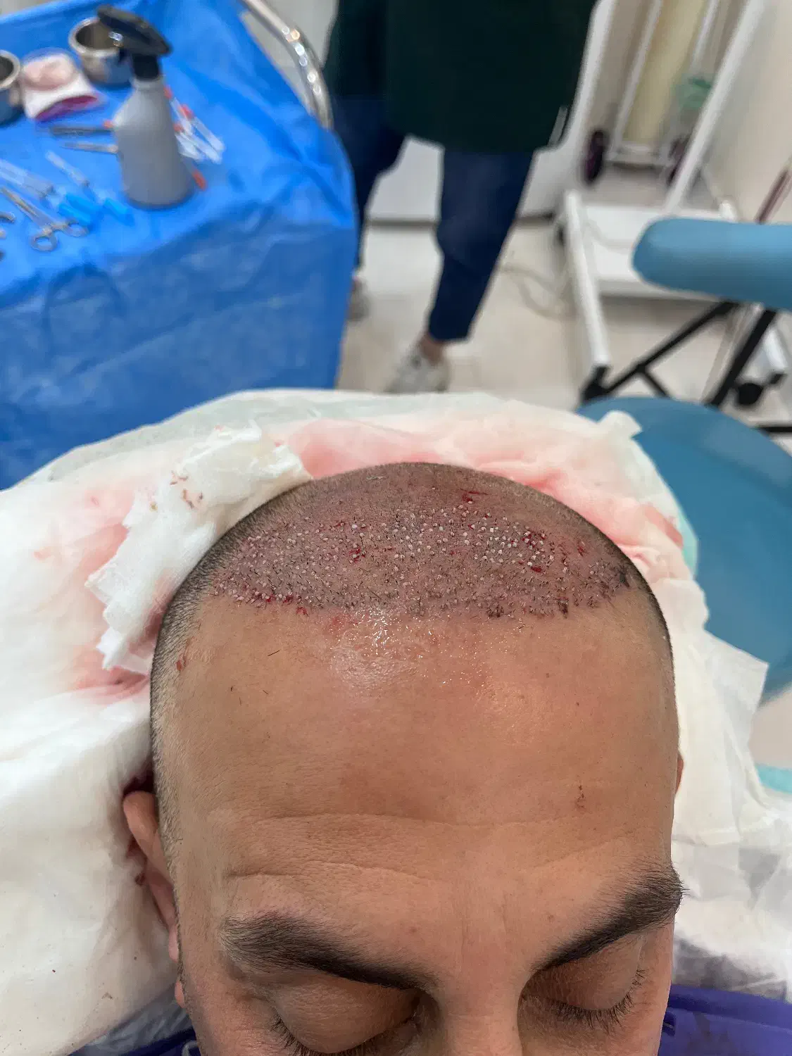 کاشت سر و ابرو|خدمات آرایشگری و زیبایی|بابل, |دیوار