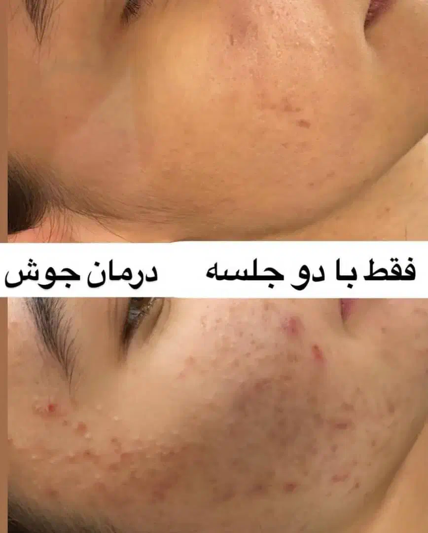 حذف تاتو با لیزر کیوسوئیچ و روشن کننده بیکینی صورت|خدمات آرایشگری و زیبایی|ارومیه, |دیوار