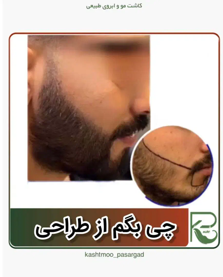 کاشت مو ابرو ریش تارکوب|خدمات آرایشگری و زیبایی|فردیس, شهرک وحدت|دیوار