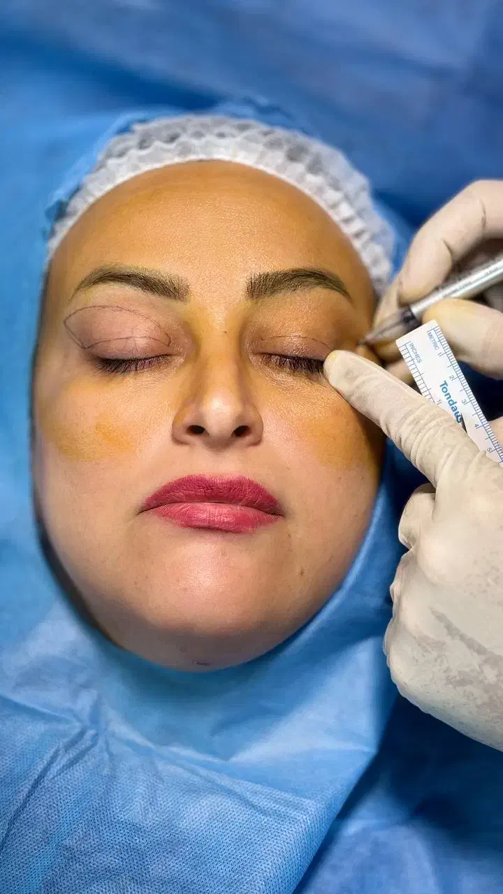 جشنواره بلفاروپلاستی جراحی پلک با بخیه لیزری|خدمات آرایشگری و زیبایی|تهران, شهرک غرب|دیوار