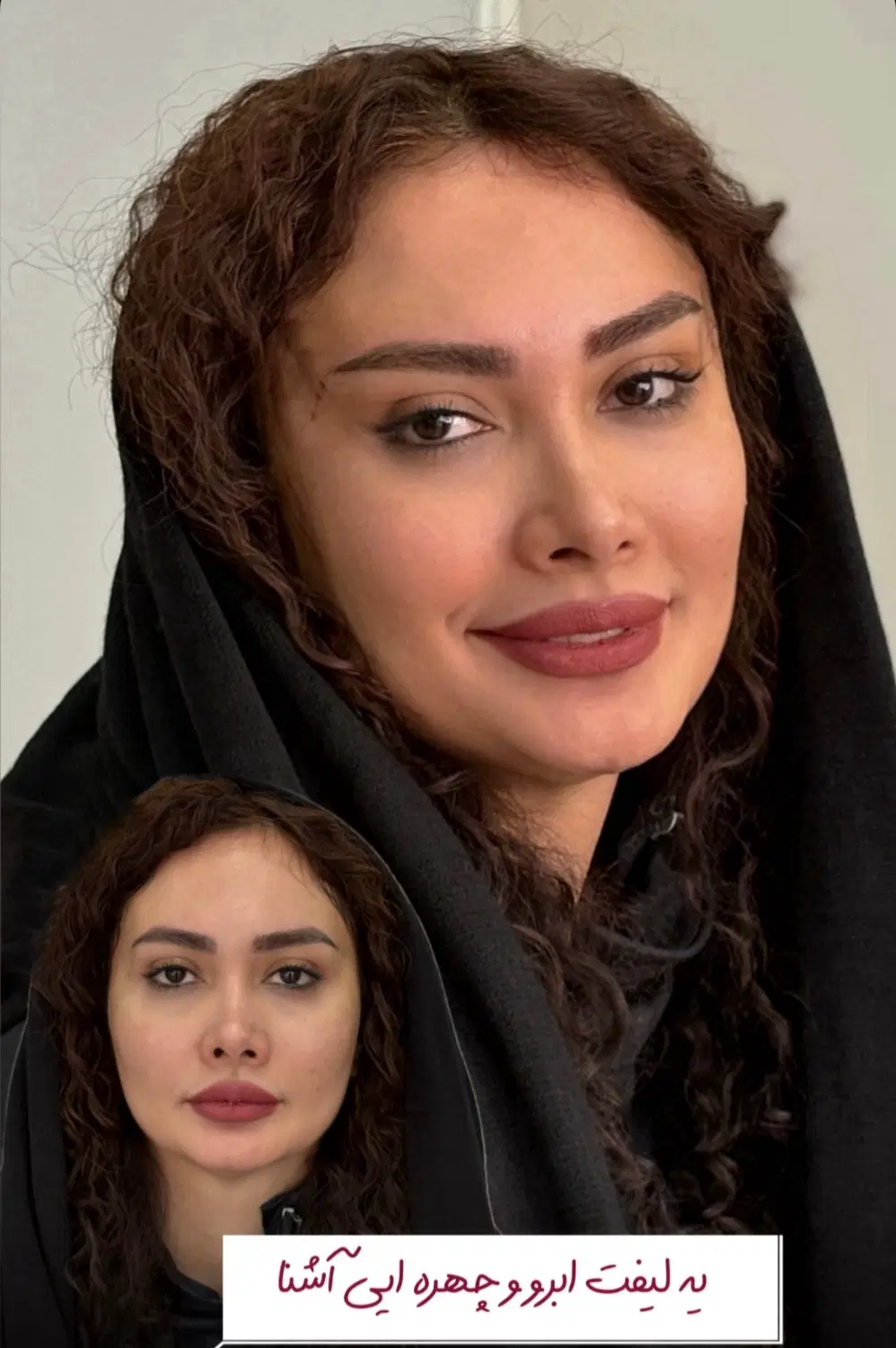 تزریق ژل و بوتاکس هایفو مزوژل|خدمات زیبایی و سلامت|تهران, شهرک شریعتی|دیوار