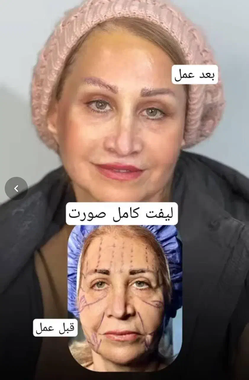 بلفارو/غبغب/سانترال/چشم گربه ایی/فیلر بادی و بکینی|خدمات آرایشگری و زیبایی|اهواز, کیانپارس |دیوار