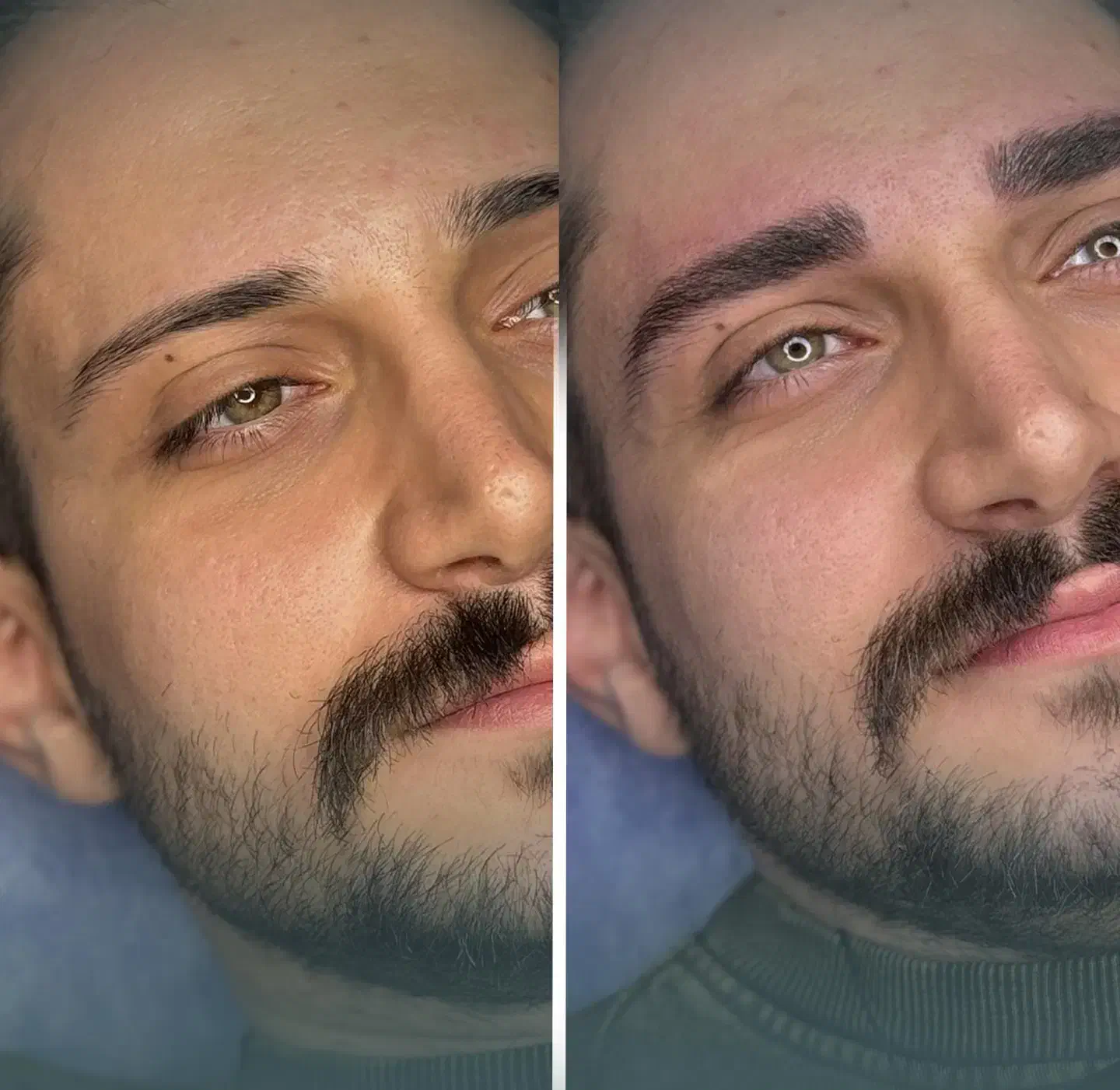 تزریق فیلر لب روسی|آرایشگاه و سالنهای زیبایی|تهران, صادقیه|دیوار