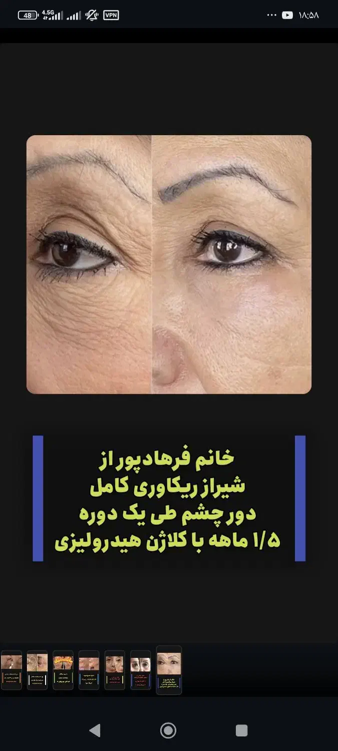 کرم بوتاکس صورت|آرایشی، بهداشتی، درمانی|اهواز, کیان اباد|دیوار