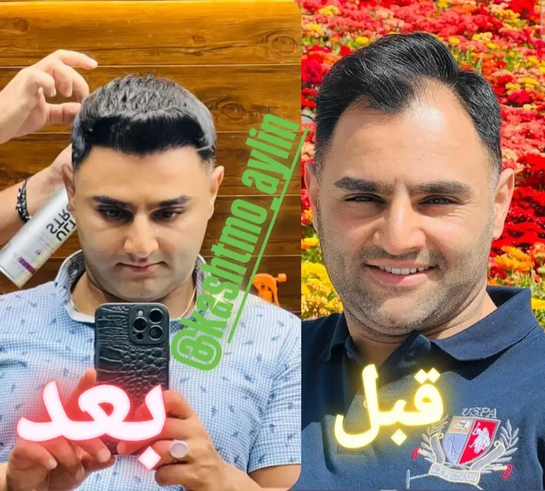 کاشت مو ابروبابروزترین متدروزدنیا|خدمات آرایشگری و زیبایی|خوی, |دیوار