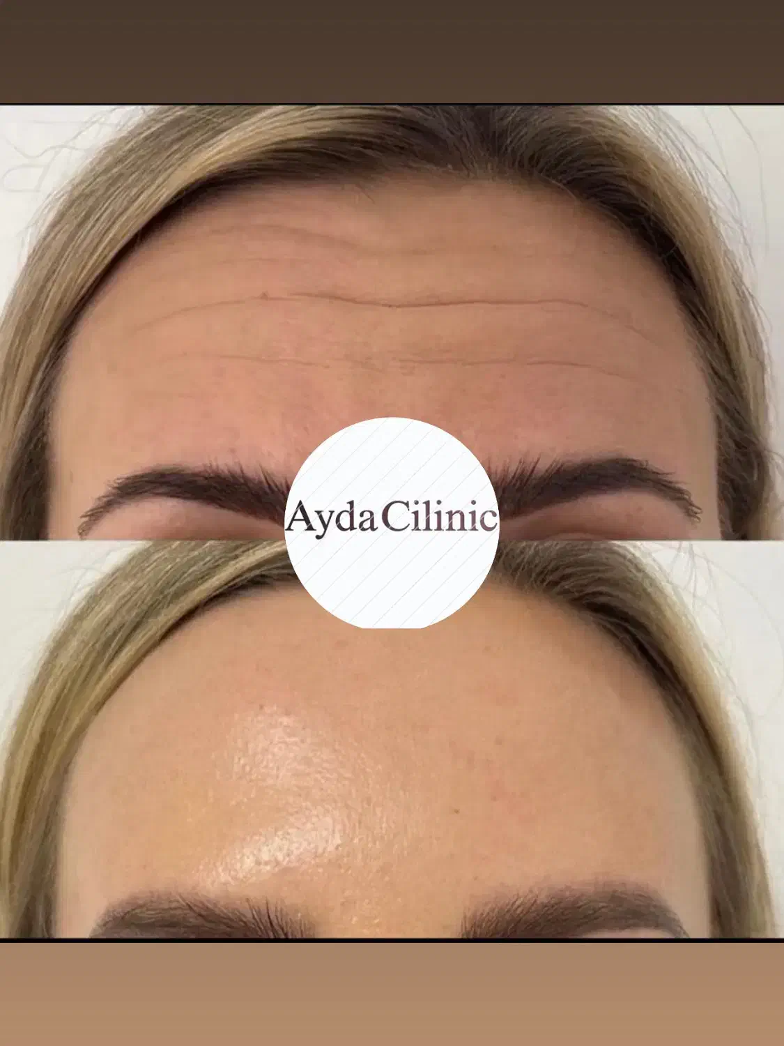 تخفیف بوتاکس و ژل|خدمات آرایشگری و زیبایی|دهگلان, |دیوار