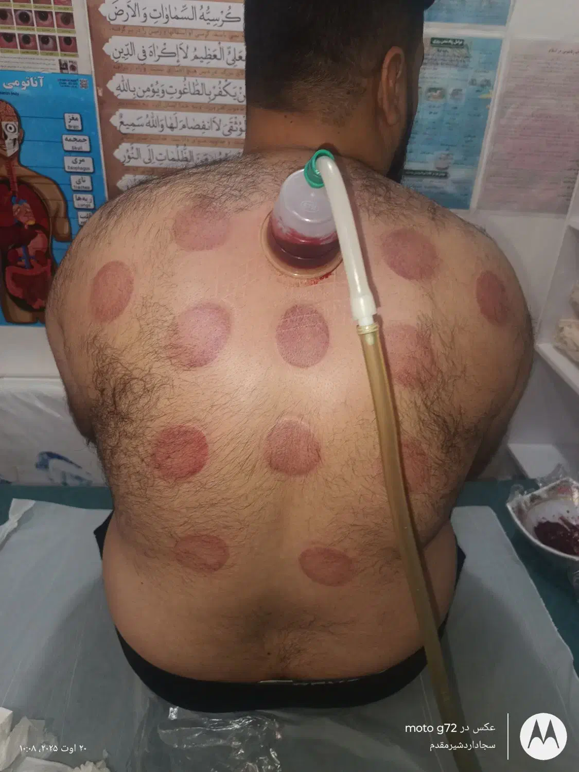 حجامت زالو فصد|آرایشی، بهداشتی، درمانی|یاسوج, |دیوار