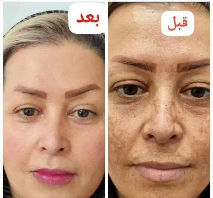پوستت روزیباترکن|خدمات آرایشگری و زیبایی|مهران (هرمزگان), |دیوار