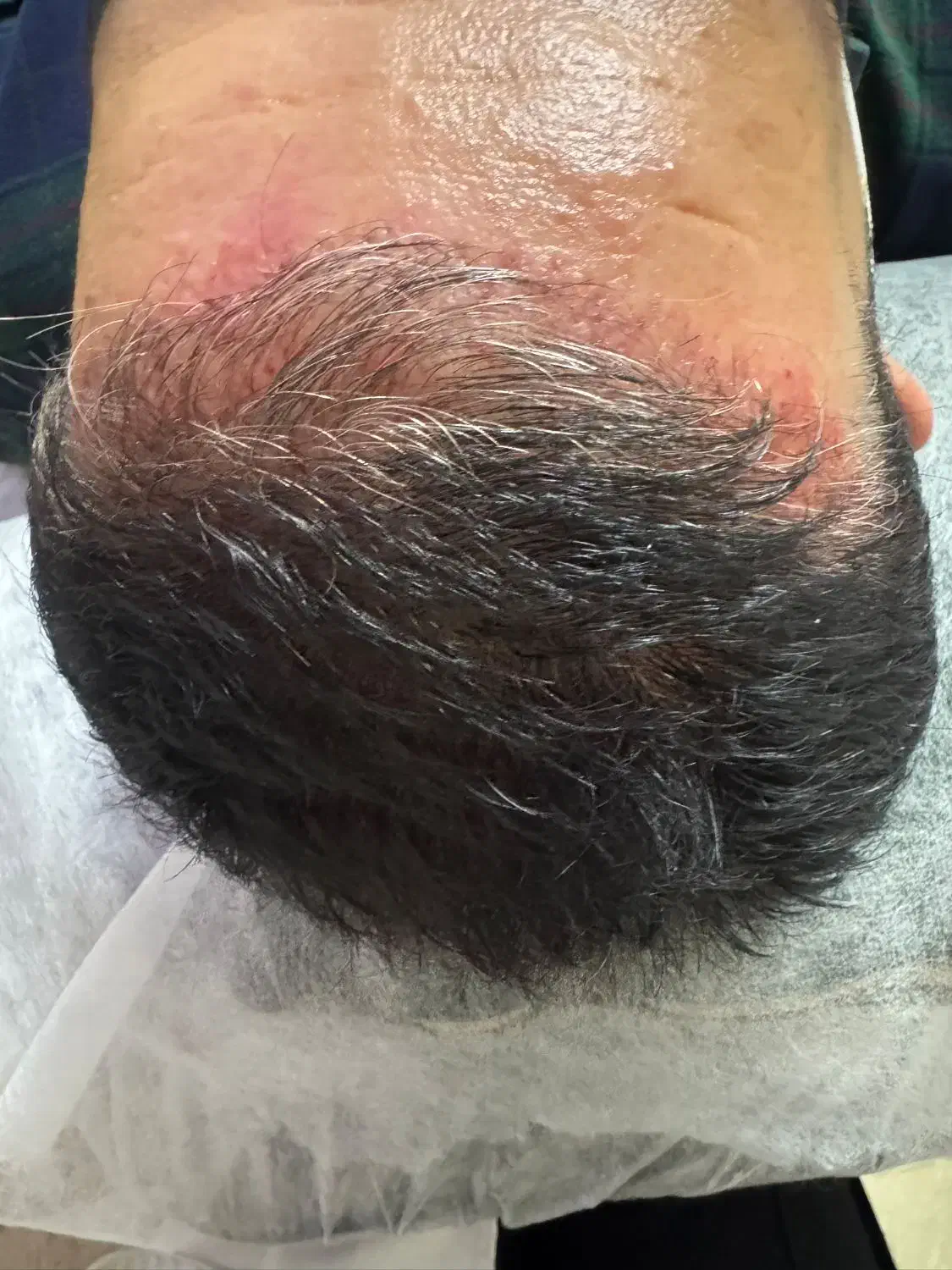 مزوتراپی مو (قطع ریزش)|خدمات آرایشگری و زیبایی|اندیشه, اندیشه فاز ۳|دیوار