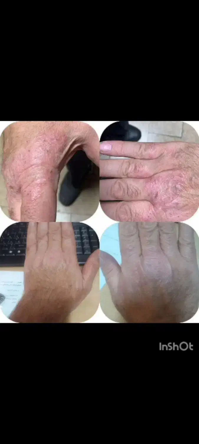 ترمیم زخم سوختگی|آرایشی، بهداشتی، درمانی|قم, حنیف نژاد|دیوار