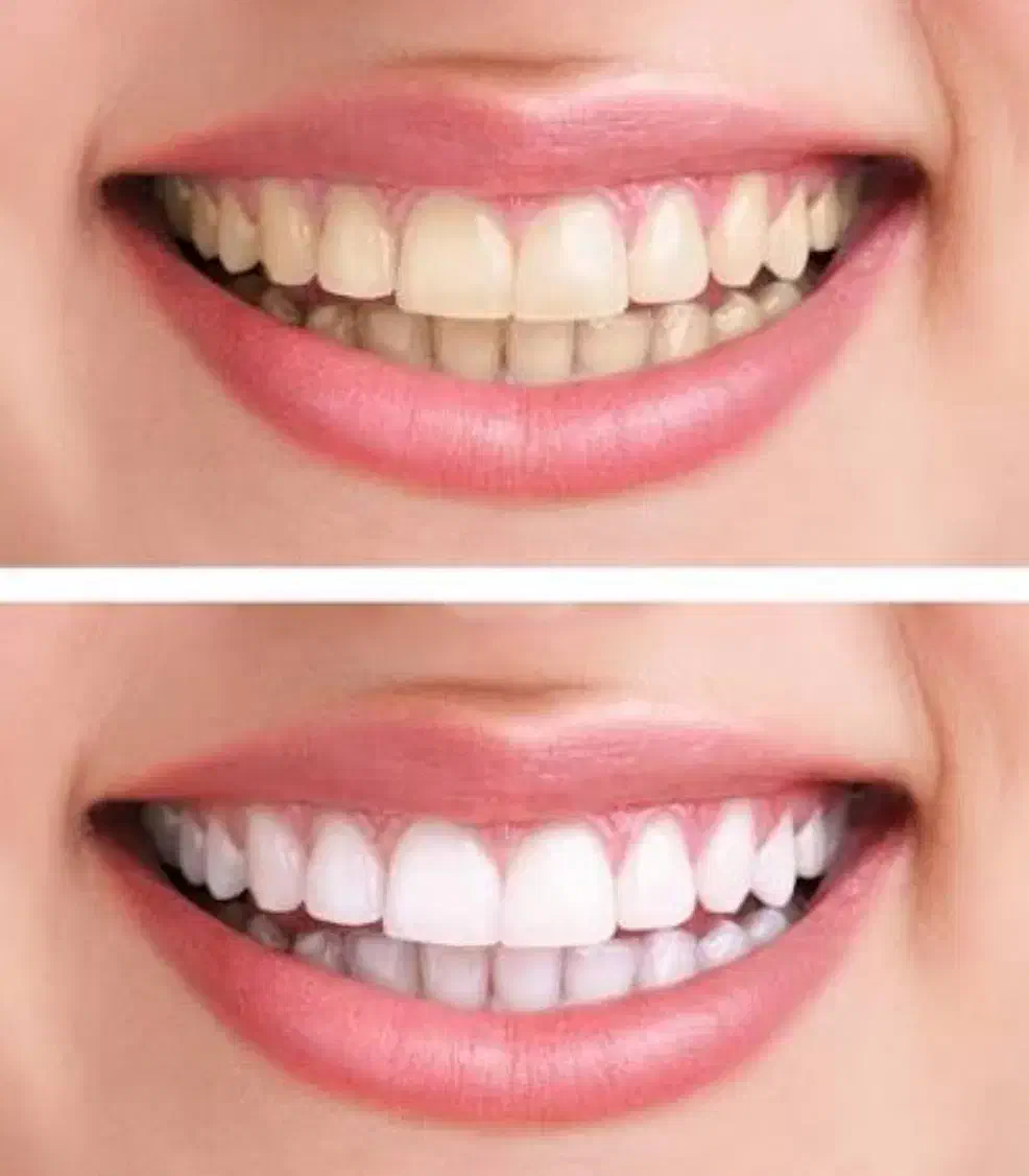 پودر سفید کننده دندان|آرایشی، بهداشتی، درمانی|اهواز, آریاشهر|دیوار