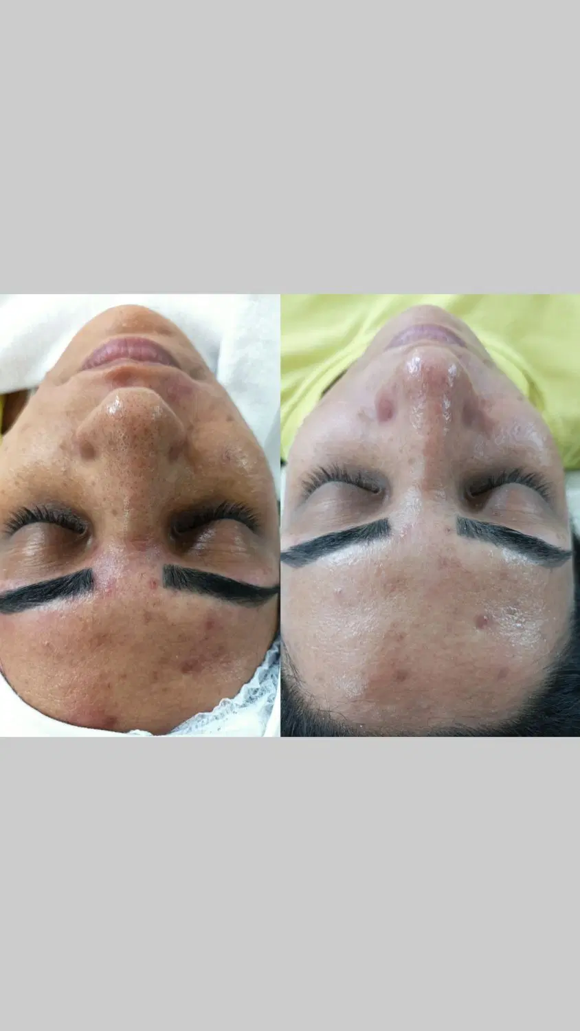 پاکسازی و فیشال تخصصی پوست در شهرری|خدمات زیبایی و سلامت|تهران, فیروزآبادی|دیوار