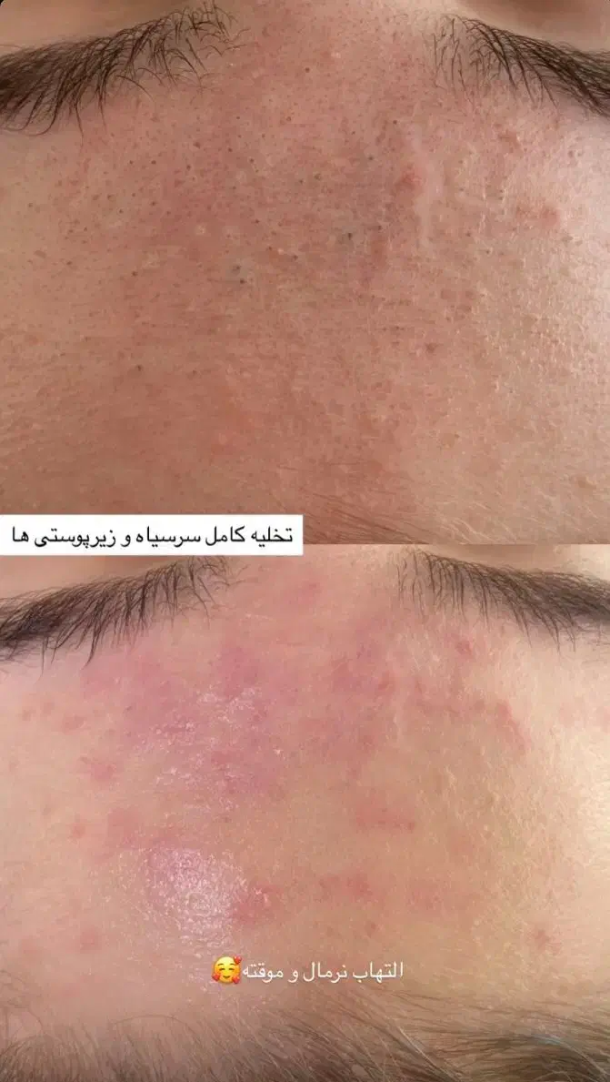 پاکسازی،فیشال درمان مشکلات پوستی|خدمات آرایشگری و زیبایی|زابل, |دیوار