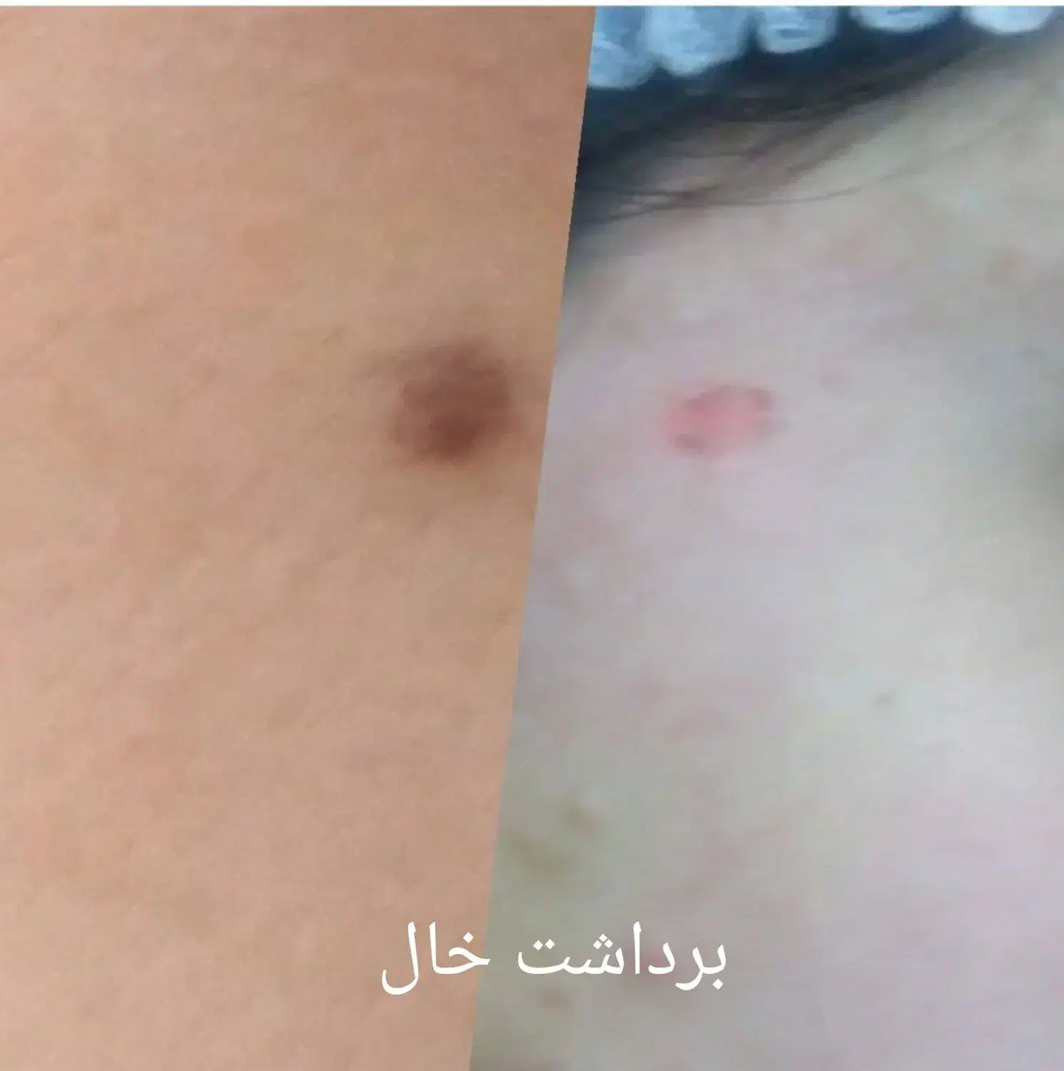 مزونیدلینگ کل صورت و پاکسازی وخالبرداری وآموزش|خدمات آرایشگری و زیبایی|یزد, |دیوار