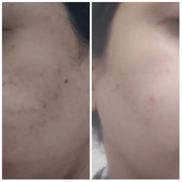 سرم گیاهی ضدجوش و لک|آرایشی، بهداشتی، درمانی|سلماس, |دیوار