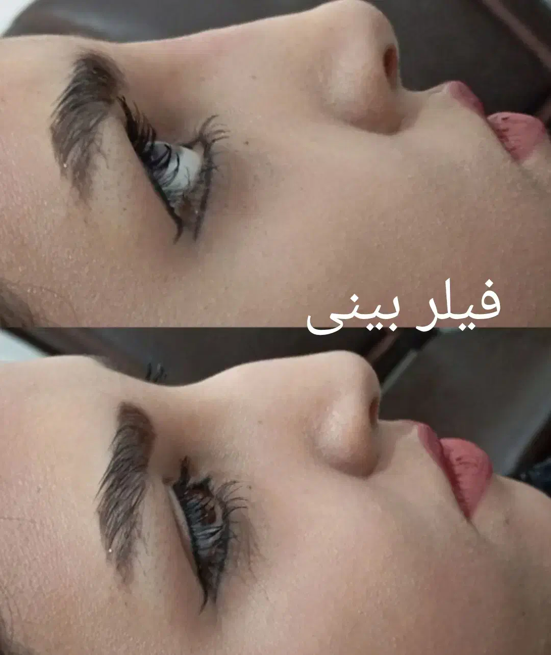 تزریق ژل بوتاکس نخ ...توسط پزشک در کلینیک سایماه|خدمات آرایشگری و زیبایی|کرمان, |دیوار