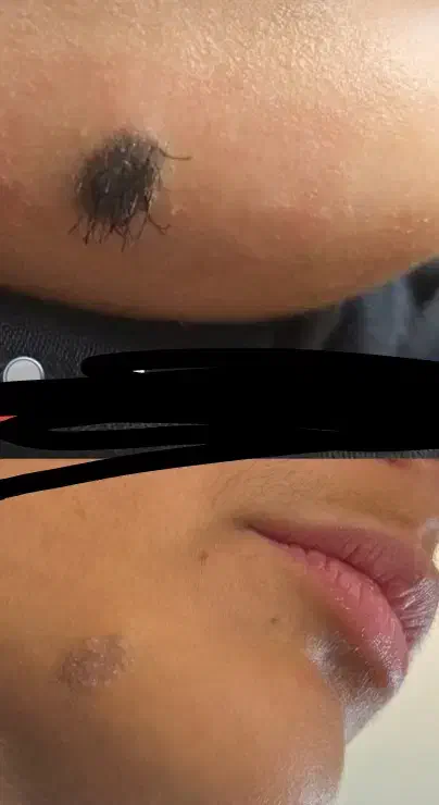 زگیل و خال|خدمات آرایشگری و زیبایی|قائن, |دیوار