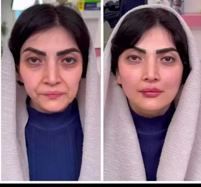 مرکز تخصصی جوانسازی فقط در ۱ جلسه/هایفو/لیفت ۸۹۰ت|خدمات آرایشگری و زیبایی|اصفهان, سودان|دیوار