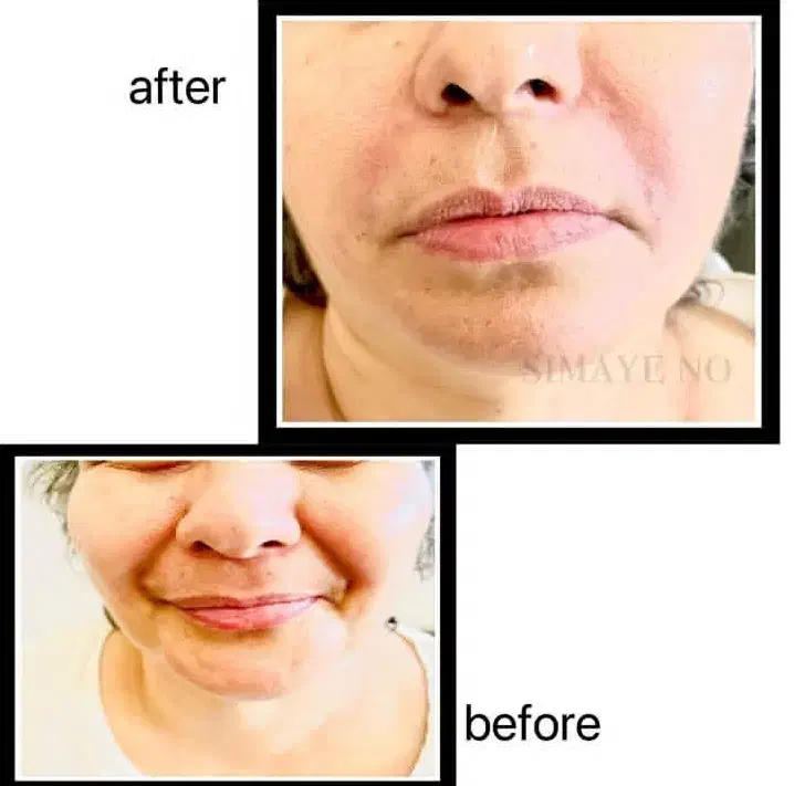 تزریق ژل و بوتاکس، نخ، مزو، فیلربادی|خدمات آرایشگری و زیبایی|ری, اقدسیه|دیوار