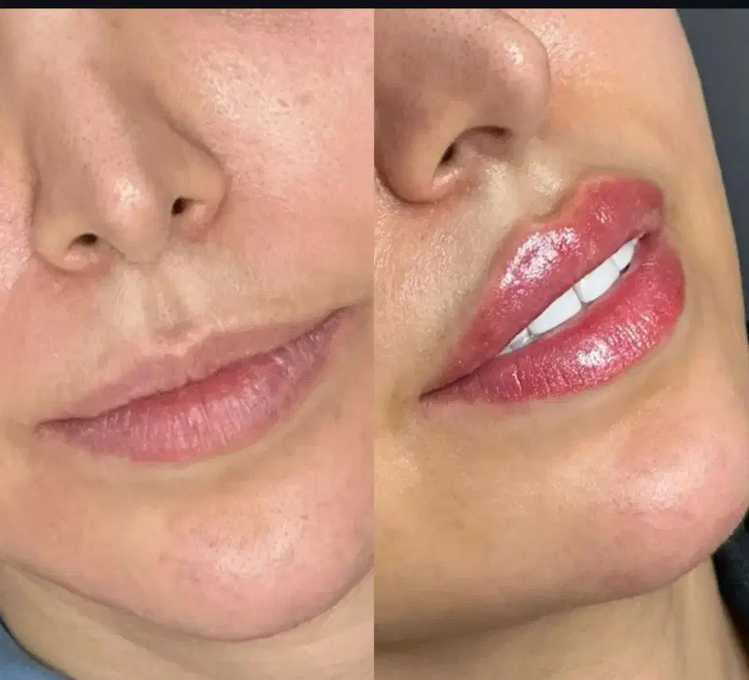 ژل و بوتاکس در منزل شما|خدمات آرایشگری و زیبایی|کرمانشاه, |دیوار