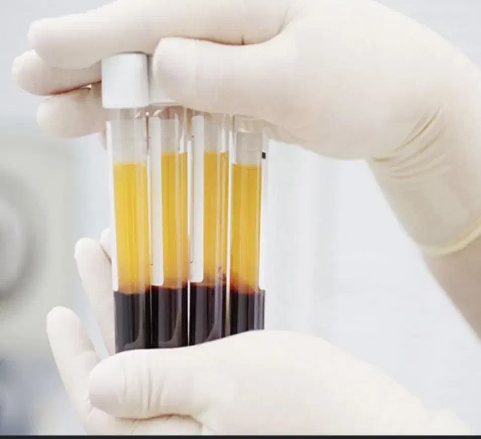 پی آرپی/مزوتراپی|خدمات آرایشگری و زیبایی|نورآباد, |دیوار