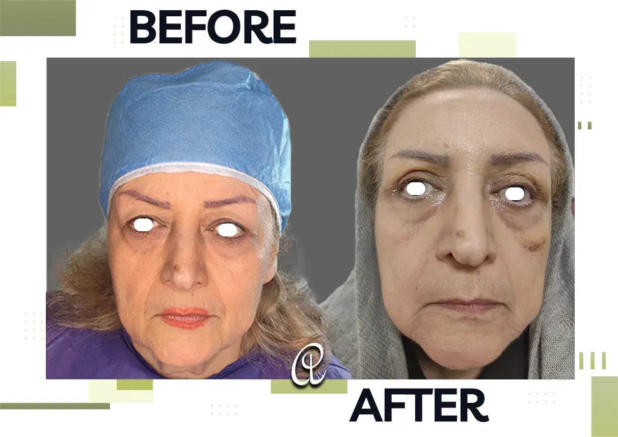 جشنواره بلفاروپلاستی جراحی پلک با بخیه لیزری|خدمات آرایشگری و زیبایی|تهران, شهرک غرب|دیوار